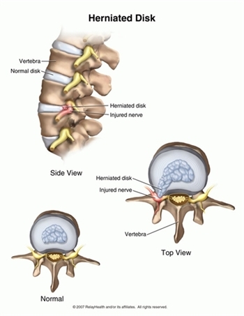 Herniated Disk