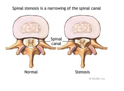 Spinal Stenosis