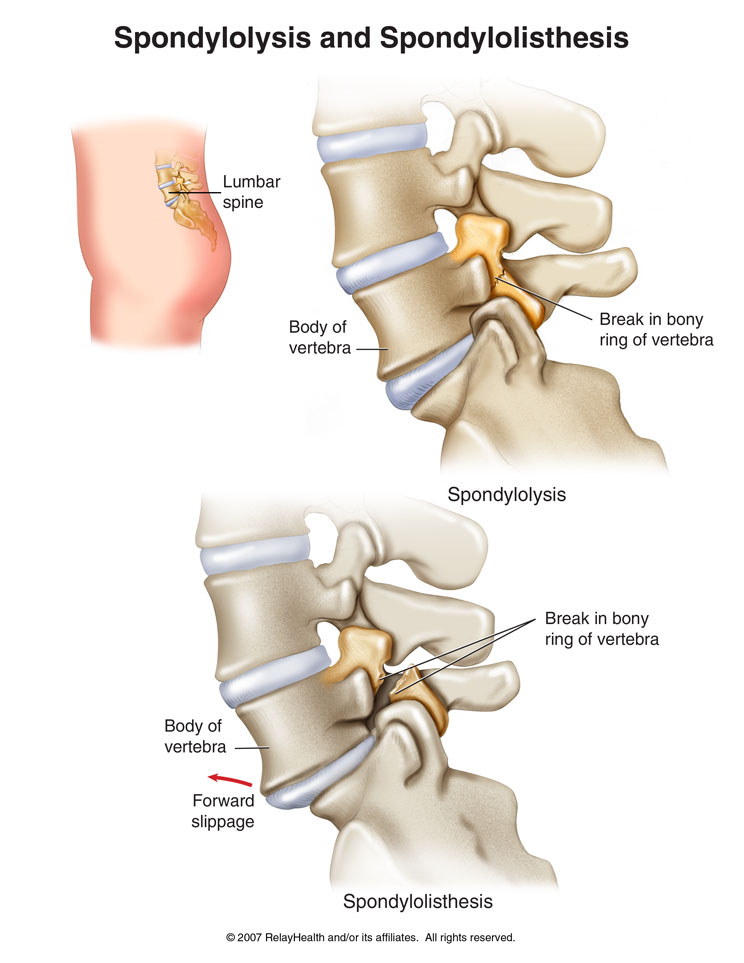 Spondylolysis and Spondylolisthesis