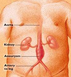 Abdominal Aortic Aneurysm