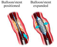 Balloon Stent